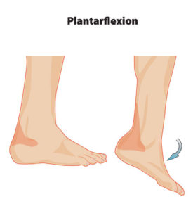 Imagen en la que se aprecia la posición de un pie normal (a la izquierda) y la posición habitual de un pie equino (derecha) que requiere para su corrección una ortesis antiequina. Ortopedia Plantia de Donostia - San Sebastián