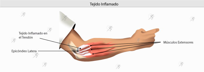 Epicondilitis, tratamiento ortésico en Ortopedia Plantia de Donostia ...