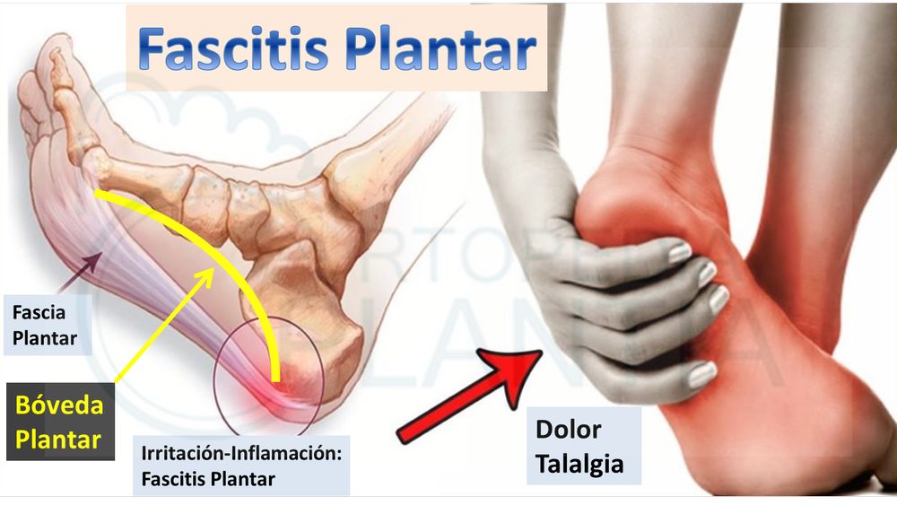 Fascitis Plantar, ¿Qué es?. Causas y Tratamientos – Ortopedia Plantia –  Donostia San Sebastián