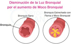 Imagen que muestra la disminución de la Luz Bronquial por el aumento de Moco o Secreción Bronquial