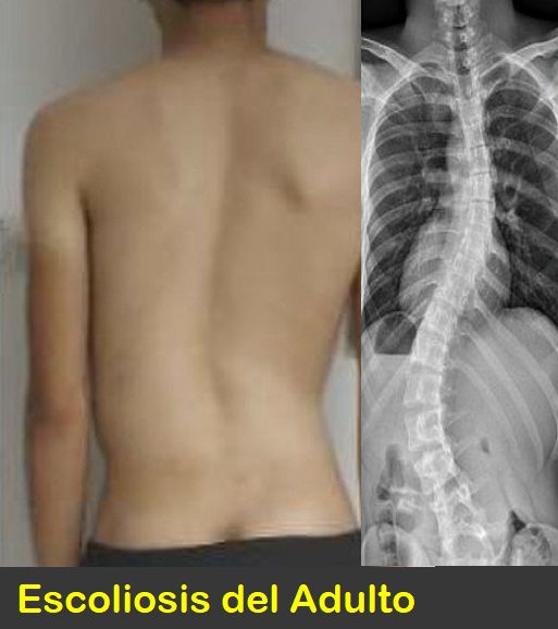 Corsé ortopédico para columna vertebral desviada