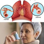 Efectos del Entrenamiento de la Musculatura Respiratoria en pacientes con Asma