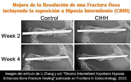 Mejora de la resolución de una fractura ósea con el uso de Hipoxia Intermitente